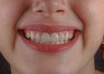Polovica Slovakov nikdy nebola na dentalnej hygiene Riziko narasta