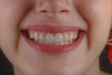Polovica Slovakov nikdy nebola na dentalnej hygiene Riziko narasta