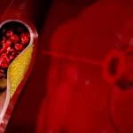 Tiché príznaky vysokého cholesterolu: Ako ich spoznať včas?